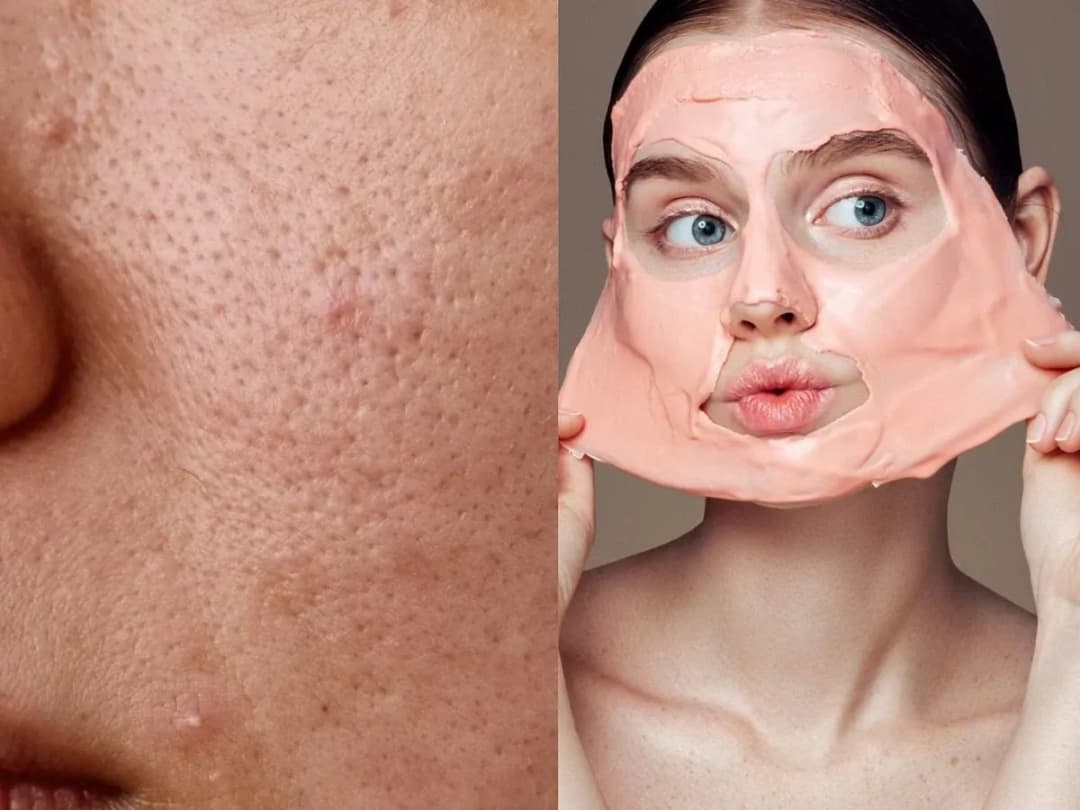 Jak wygląda zapchana cera? Objawy, przyczyny i skuteczne rozwiązania