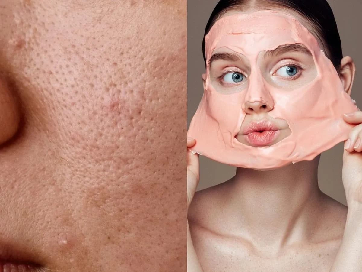 Jak wygląda zapchana cera? Objawy, przyczyny i skuteczne rozwiązania